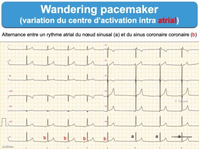 Wandering Pacemaker (WPM) : E-cardiogram