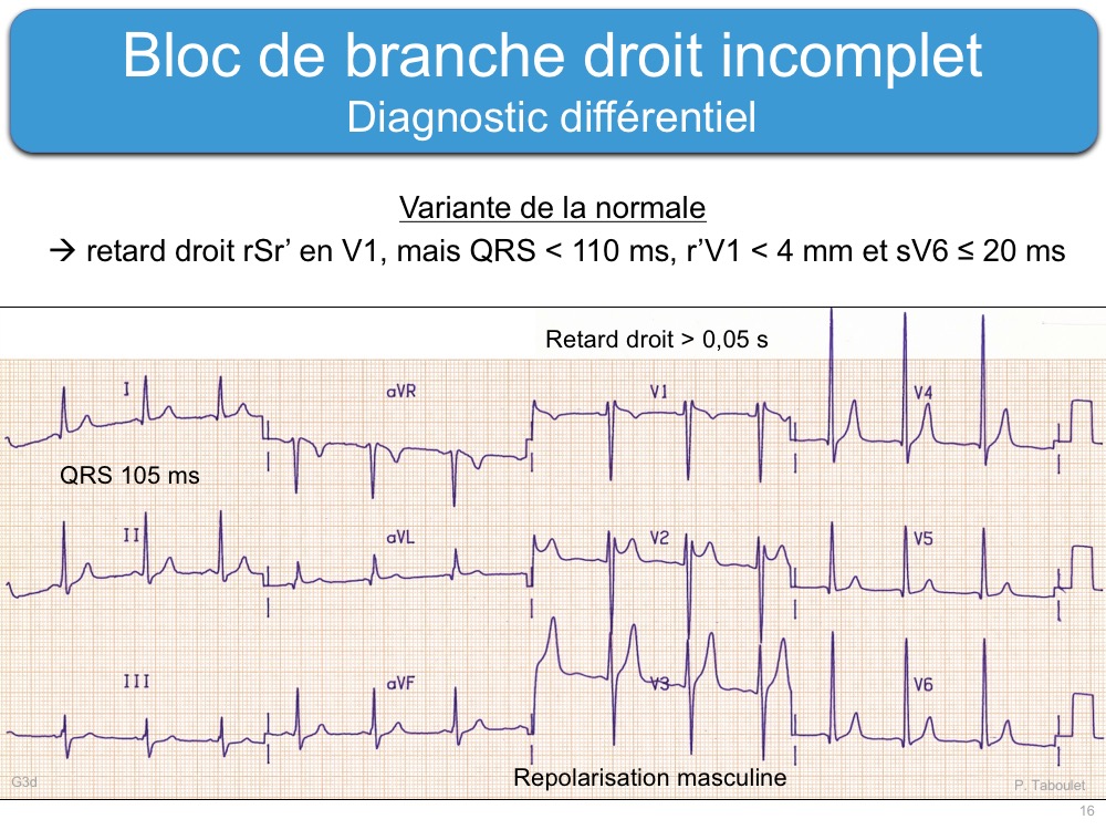 Bloc De Branche 2. Droit Incomplet : E-cardiogram