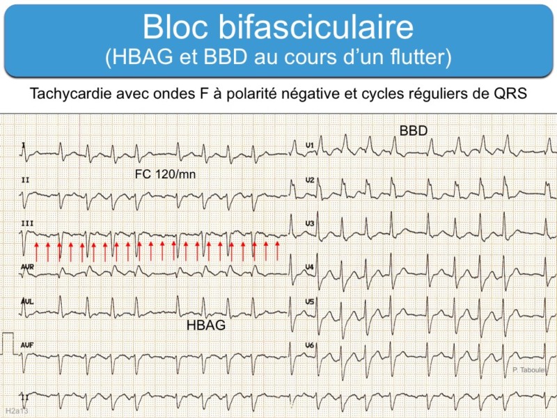 Bloc Bifasciculaire : E-cardiogram