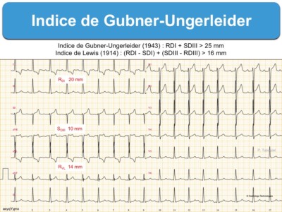 Indice D’HVG : 5. Gubner-Ungerleider : E-cardiogram