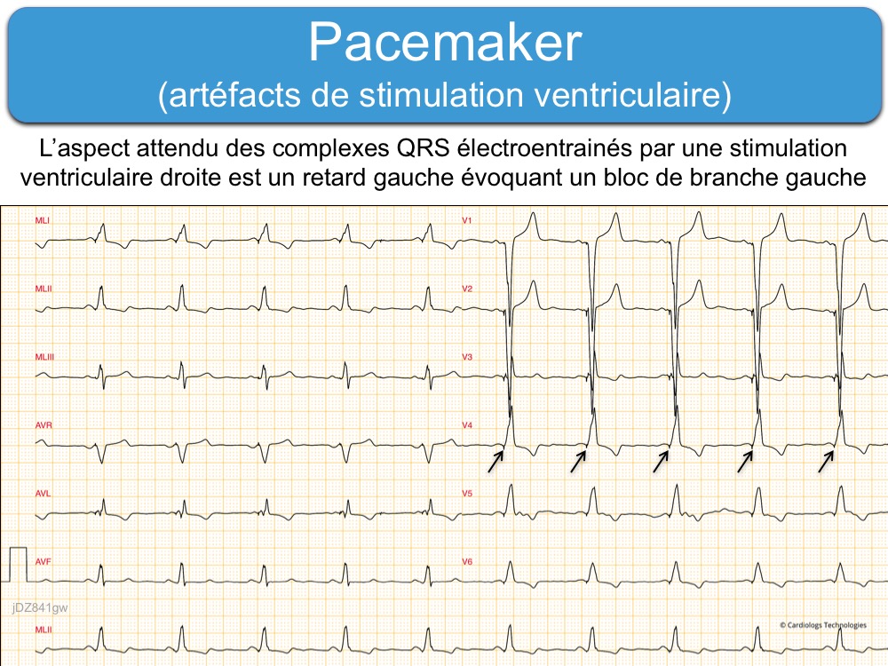 Pacemaker (c) signes ECG : e-cardiogram