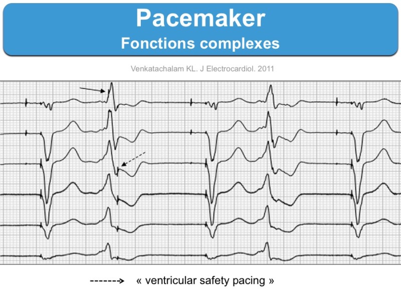 Pacemaker (e) Fonctions Complexes : E-cardiogram