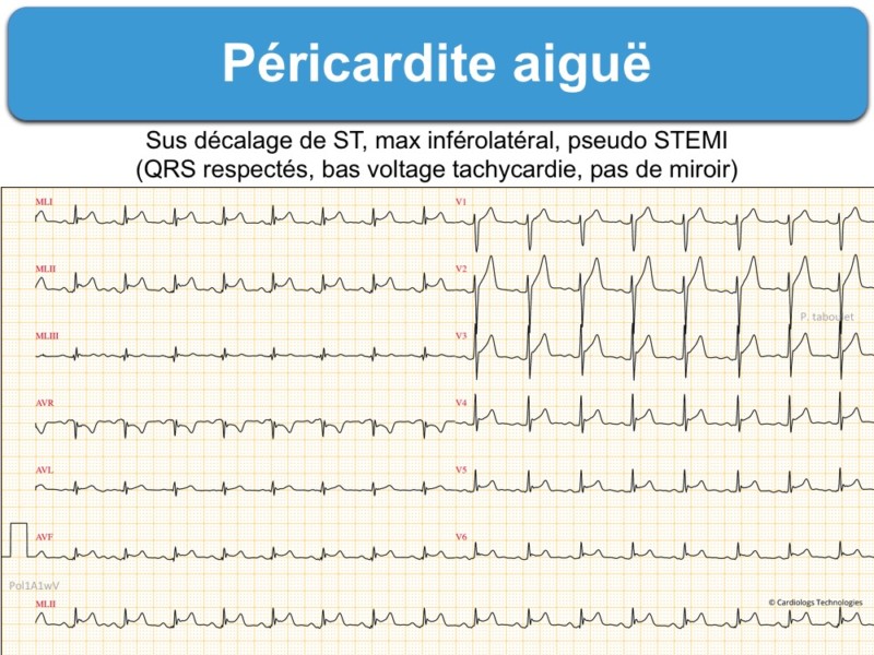 Péricardite aiguë. 2 atypique : e-cardiogram