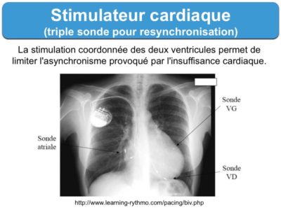 Pacemaker (b) électronique : E-cardiogram