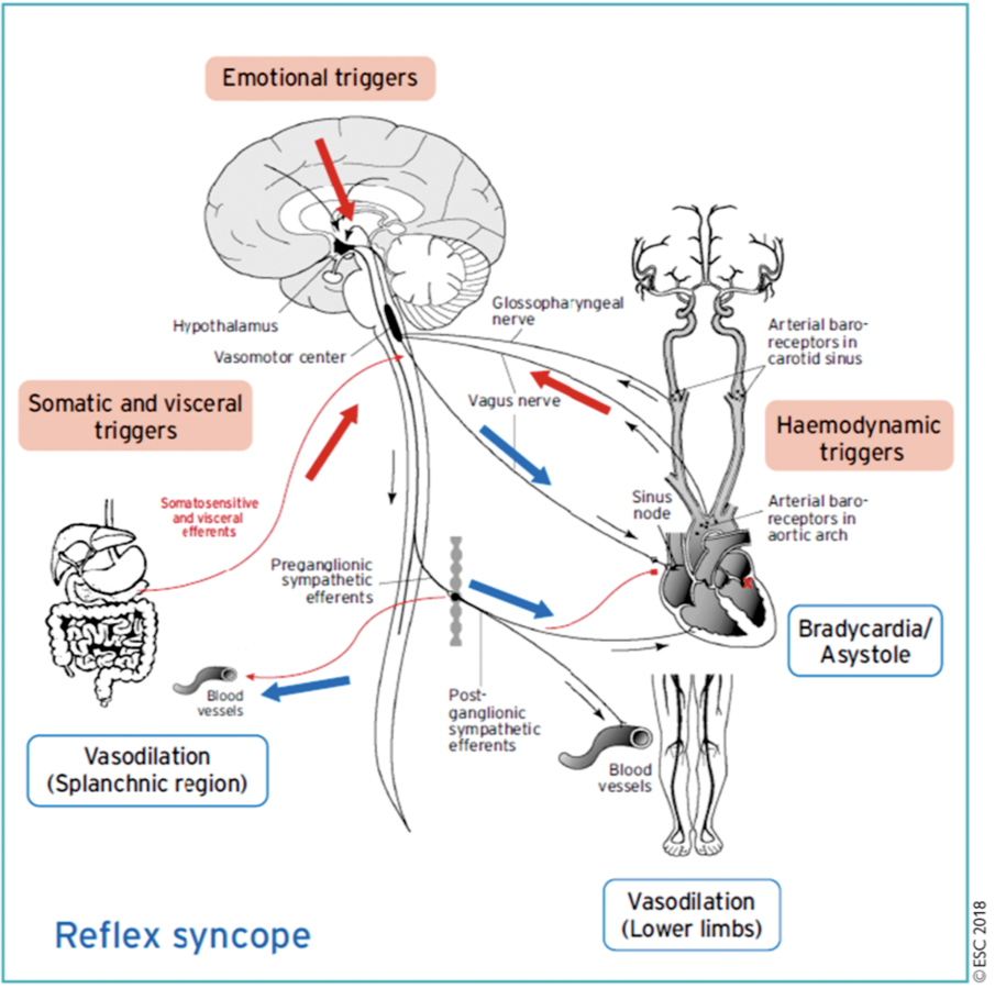 Syncope Réflexe : E-cardiogram