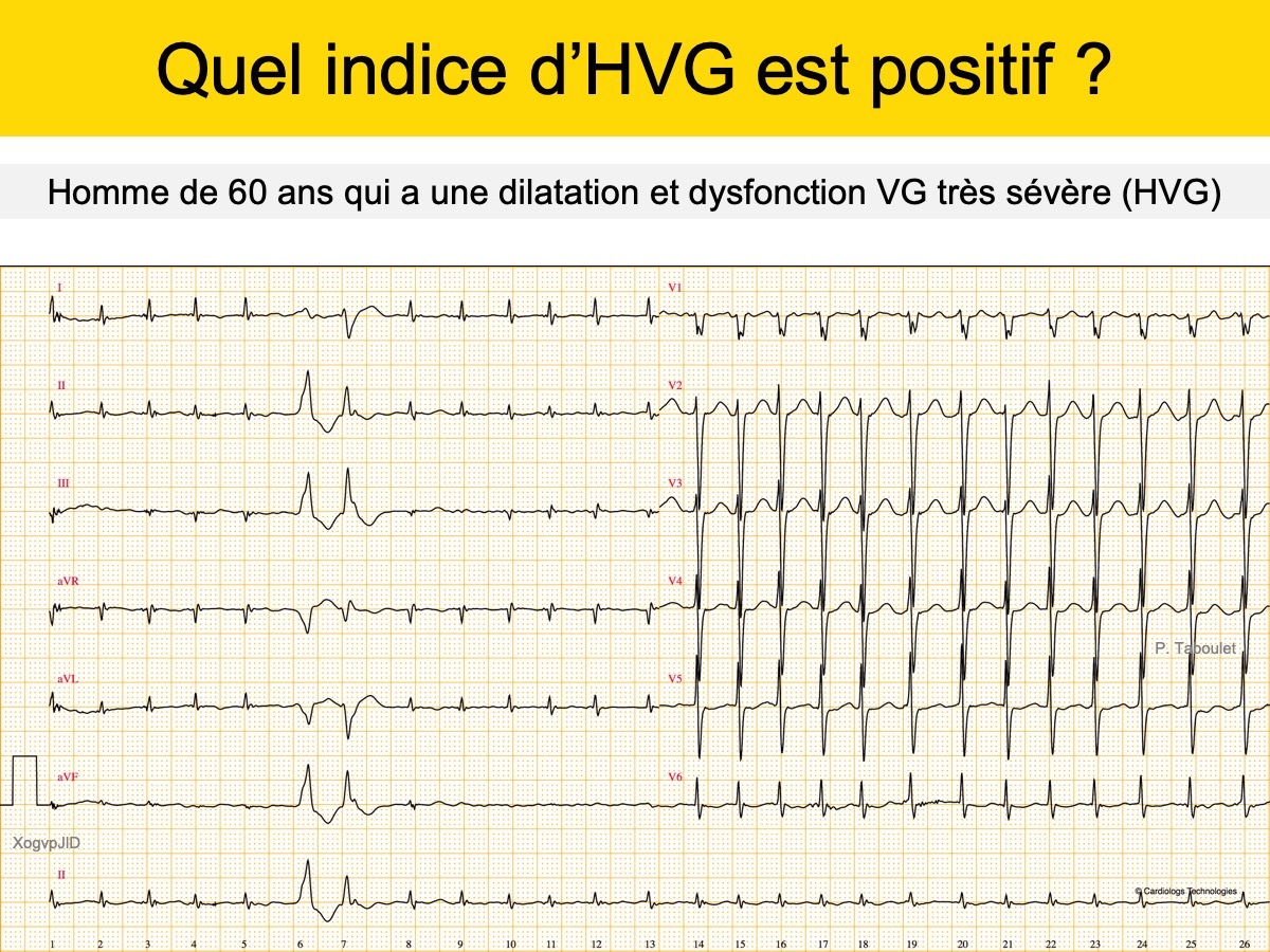 Bloc De Branche 3. Gauche Complet : E-cardiogram