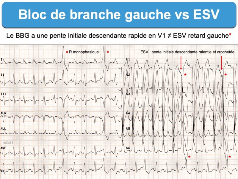 Bloc De Branche 3. Gauche Complet : E-cardiogram