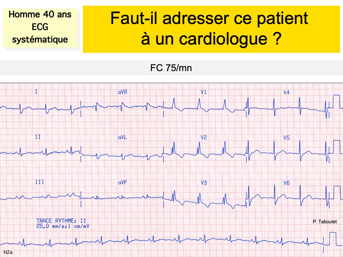 BLOC DE BRANCHE DROIT : E-cardiogram