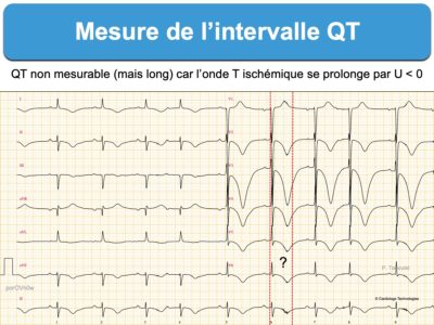 Intervalle QT. 1. Mesure : E-cardiogram