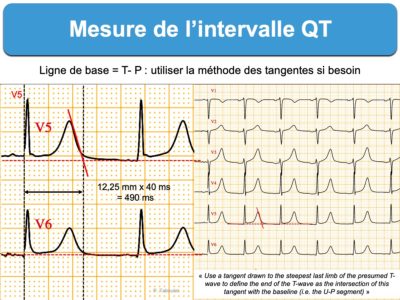 Intervalle QT. 1. Mesure : E-cardiogram