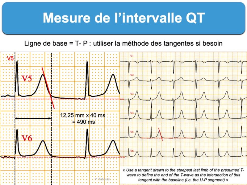 Intervalle QT. 1. Mesure : E-cardiogram