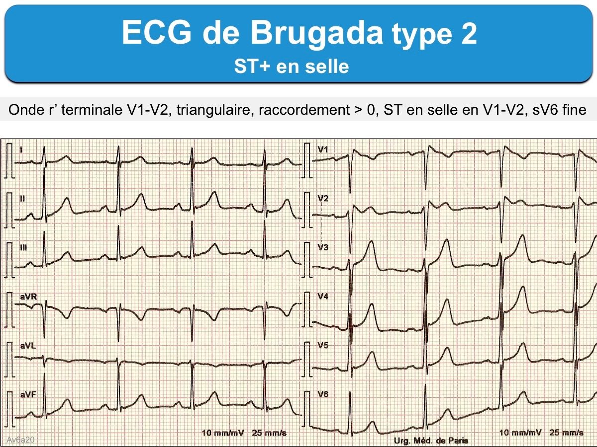 Синдром бругада на экг фото