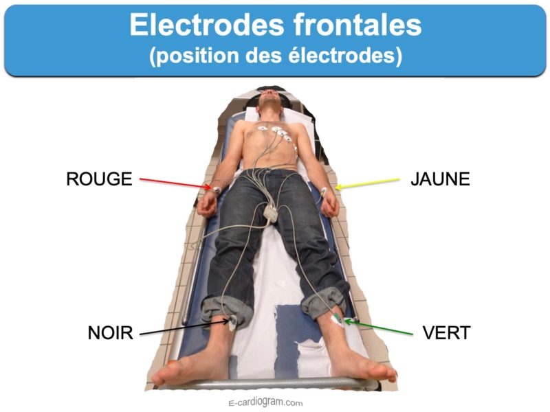 Electrodes Frontales : E-cardiogram