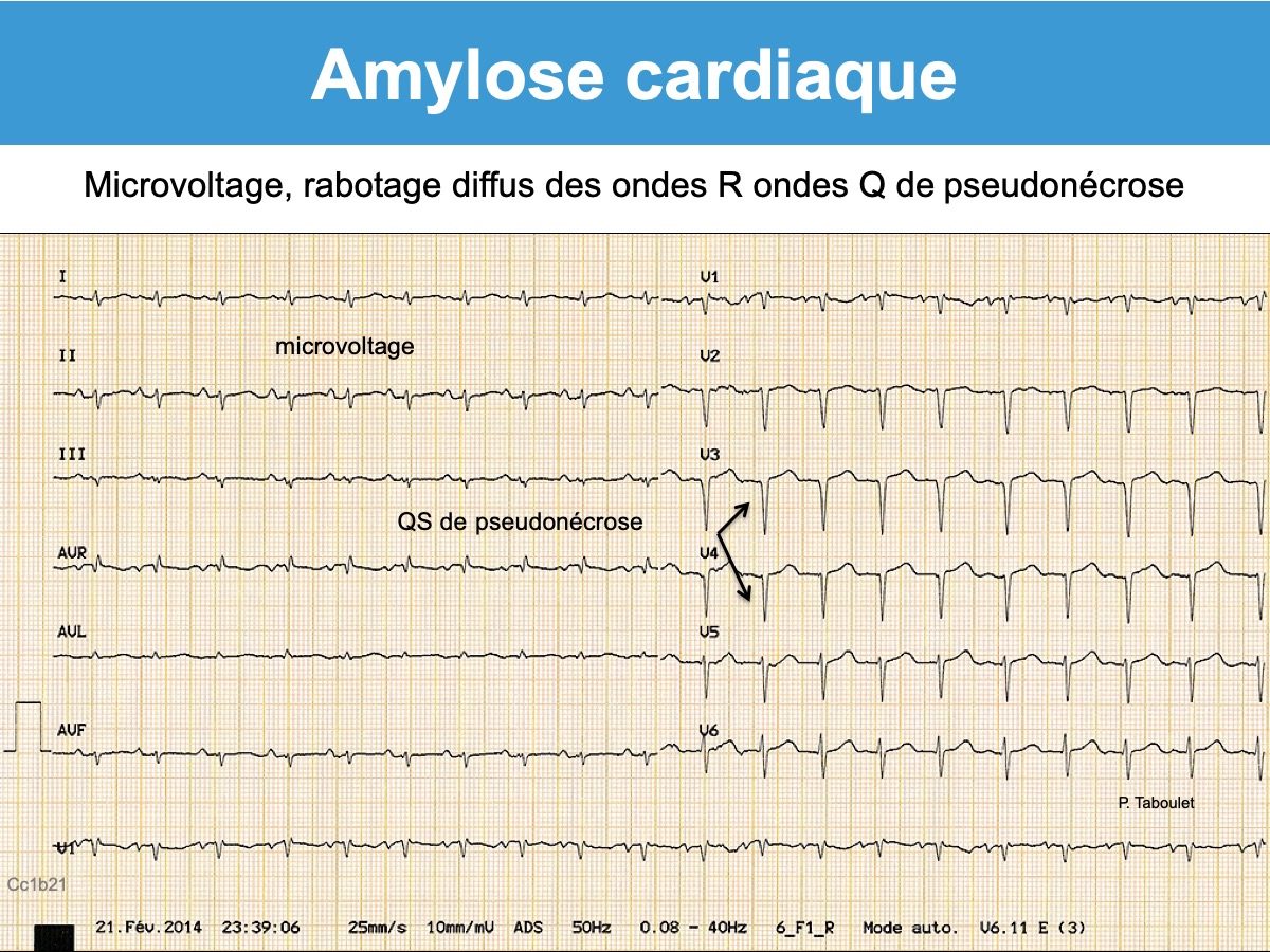 Amylose Cardiaque E Cardiogram