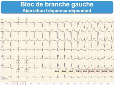 Bloc de branche 3. gauche incomplet : e-cardiogram