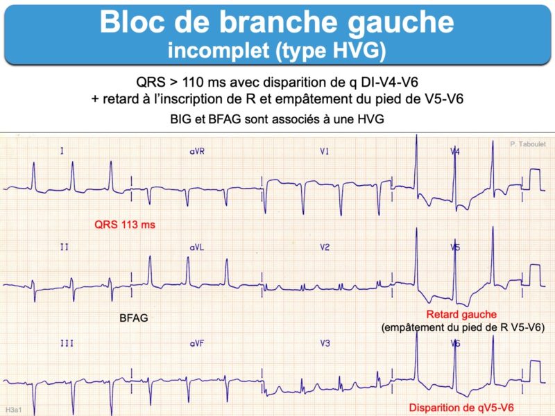 Bloc de branche 3. gauche incomplet : e-cardiogram