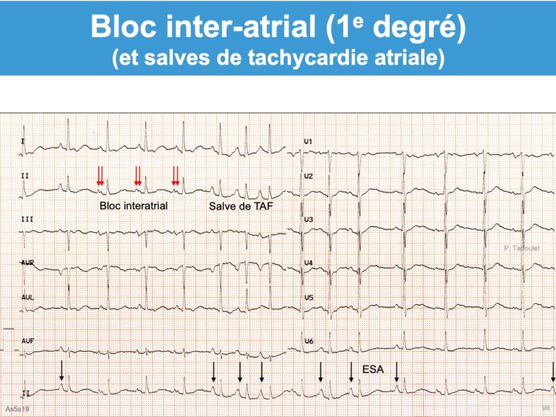 Hypertrophie atriale gauche (HAG) : e-cardiogram