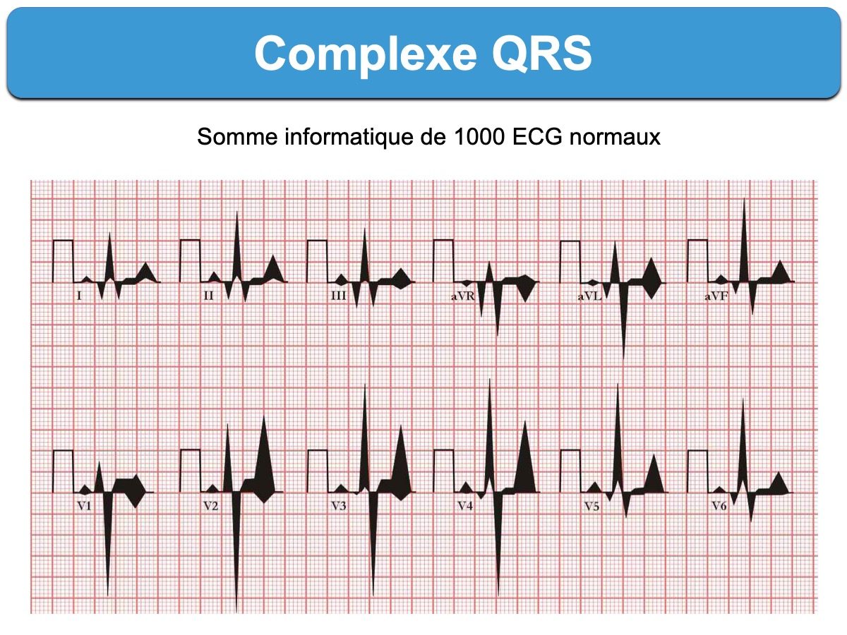 complexe-qrs-e-cardiogram