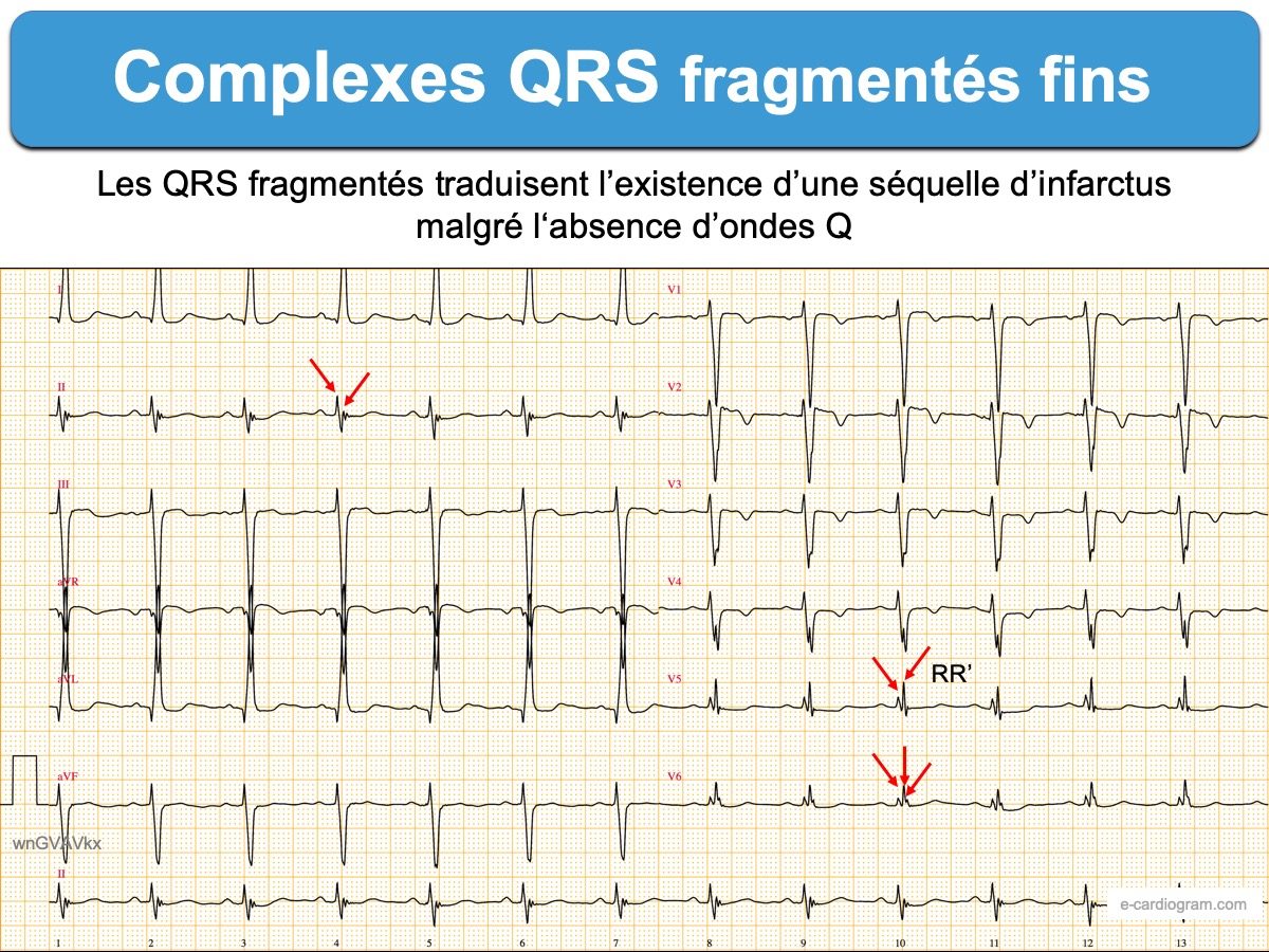 Complexes QRS Fragmentés 1. Fins : E-cardiogram