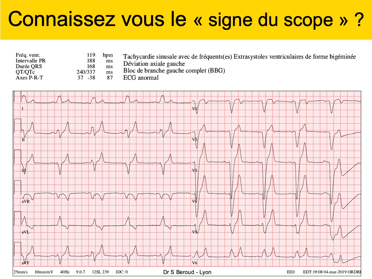 Bloc De Branche 2. Droit Complet : E-cardiogram