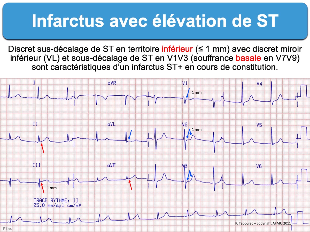 Infarctus 2 Avec Elevation Du St E Cardiogram