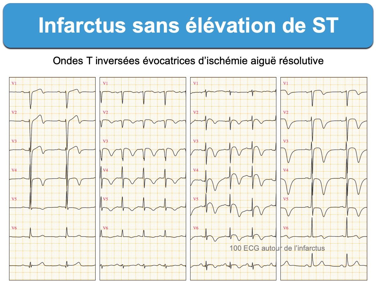 Infarctus 3 Sans Elevation Du St E Cardiogram