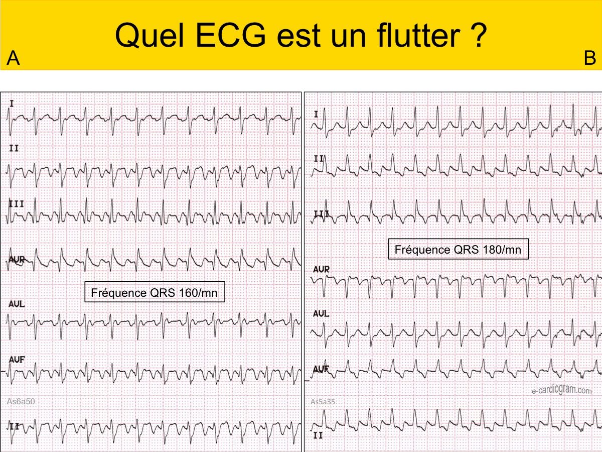 ECG : Normal : E-cardiogram