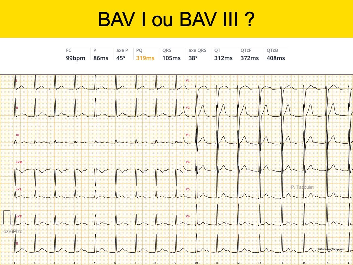 ECG : Sportif Normal : E-cardiogram