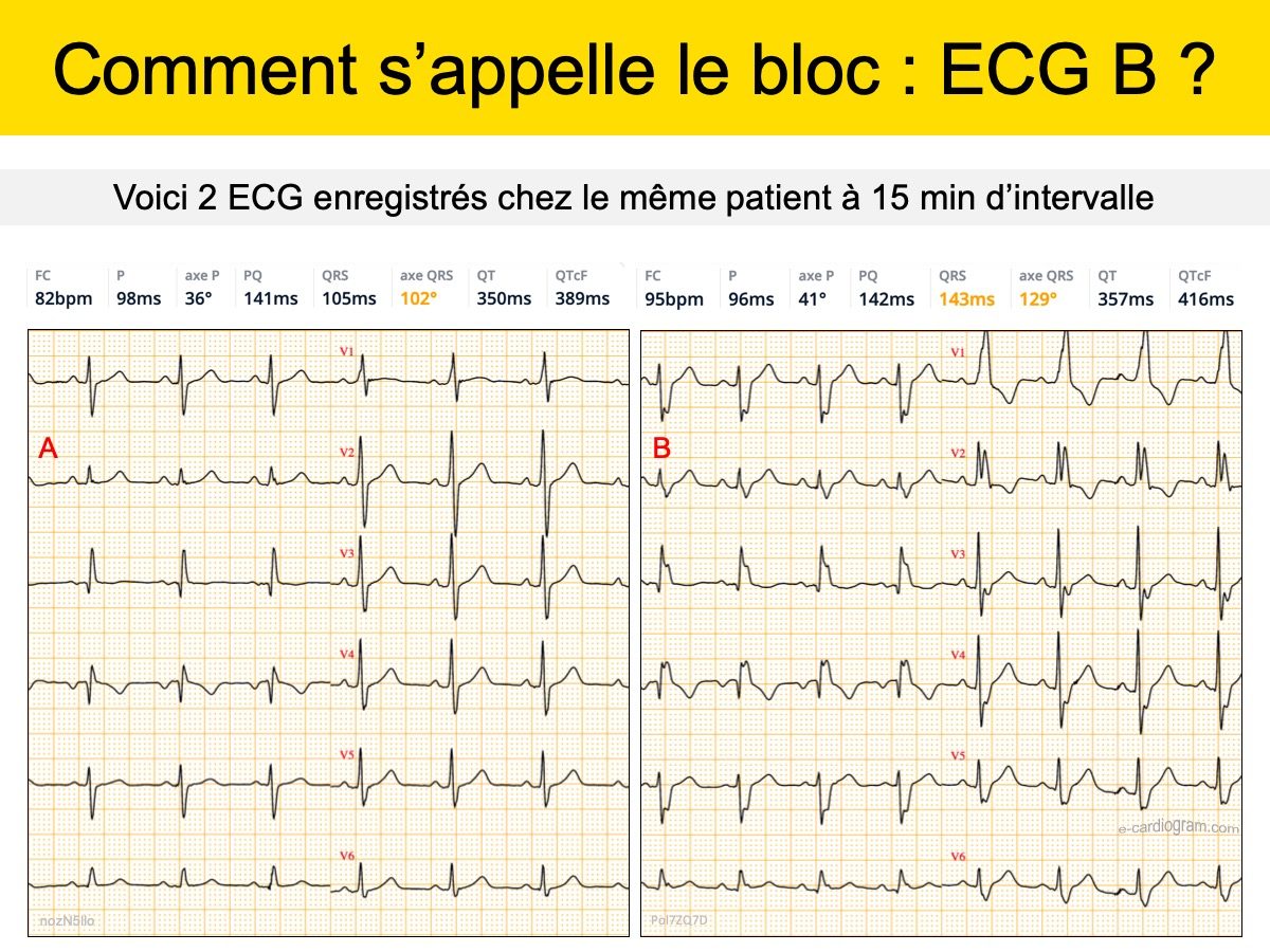 AMIODARONE : E-cardiogram