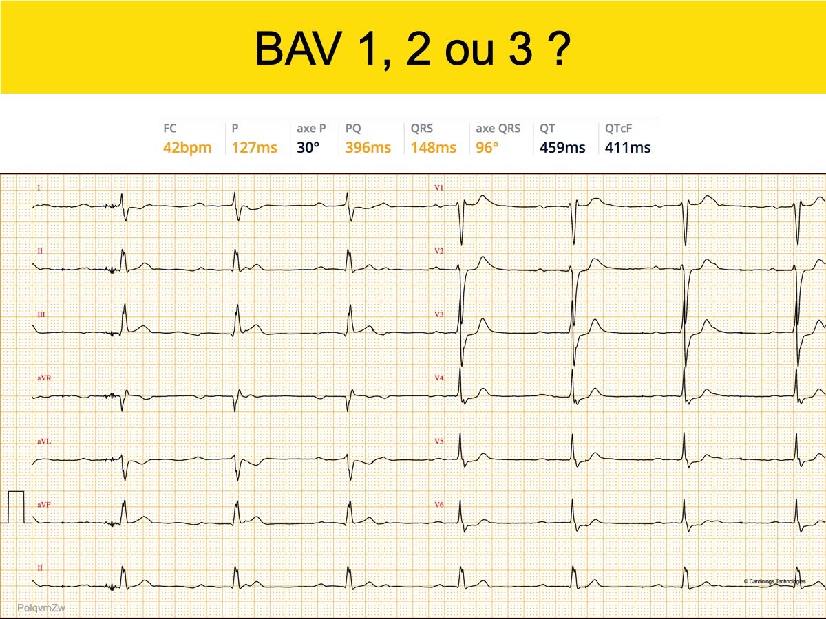 Bloc De Branche 2. Droit Complet : E-cardiogram