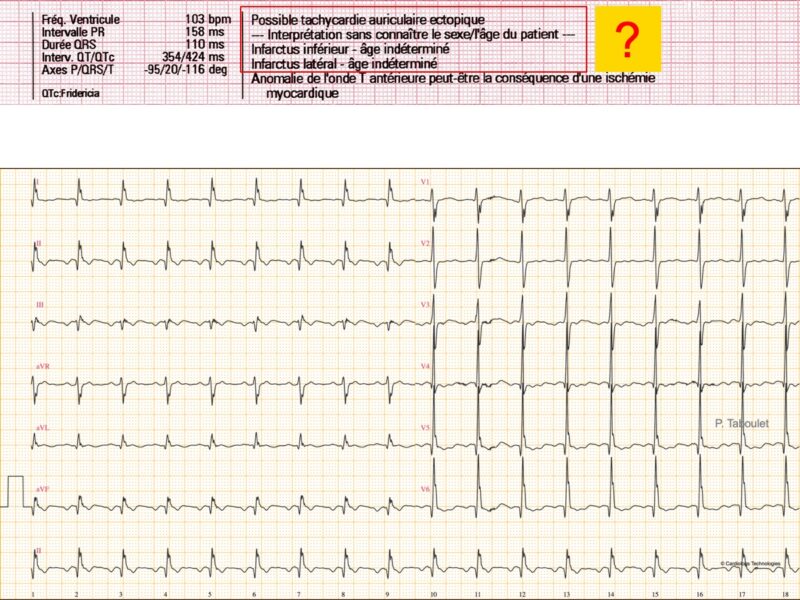 Indice D’HVG : 2. Sokolow-Lyon : E-cardiogram