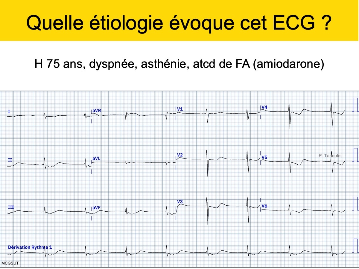 Syndrome de Brugada. : e-cardiogram